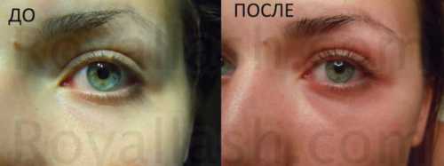 восстановление и беременность после выскабливания замершей беременности или полипа эндометрия восстановление и беременность после выскабливания замершей беременности или полипа эндометрия